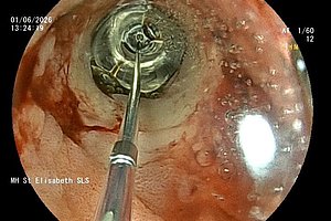 Endoskopische Aufnahme eines medizinischen Instruments im Inneren eines Organs mit sichtbarer Schleimhaut und Gewebe