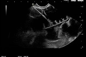 Schwarz-weiße Ultraschallaufnahme mit sichtbaren medizinischen Instrumenten und Gewebestrukturen