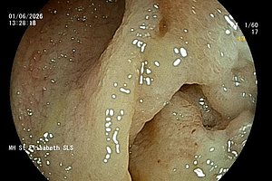 Endoskopische Aufnahme von Schleimhaut mit unregelmäßiger Oberfläche und glänzenden Reflexen