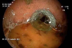 Endoskopische Aufnahme des Mageneingangs mit sichtbarem Metallstent und Schleimhautoberfläche